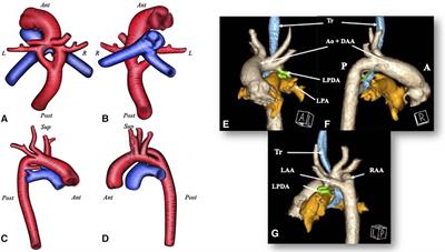 Case Report: An unusual case of a transposition of the great arteries with a double aortic arch: a highly complex fetal diagnosis with an unpredictable outcome
